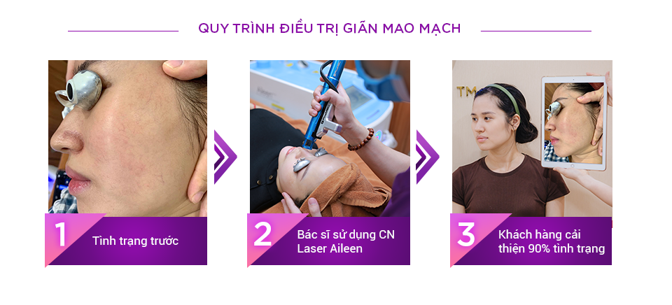 Quy trình điều trị giãn mao mạch tại Thẩm mỹ Hoàng Tuấn